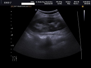 Ultraschall Bauch linke Niere