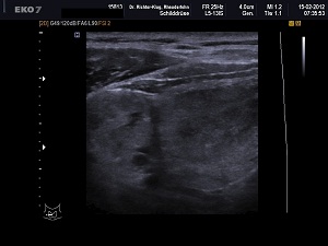 Ultraschall Schilddrüse rechts quer