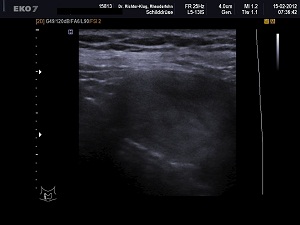 Ultraschall Schilddrüse rechts längs