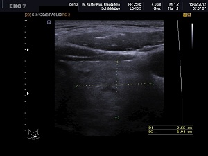 Ultraschall Schilddrüse links quer