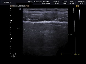 Ultraschall Schilddrüse links längs